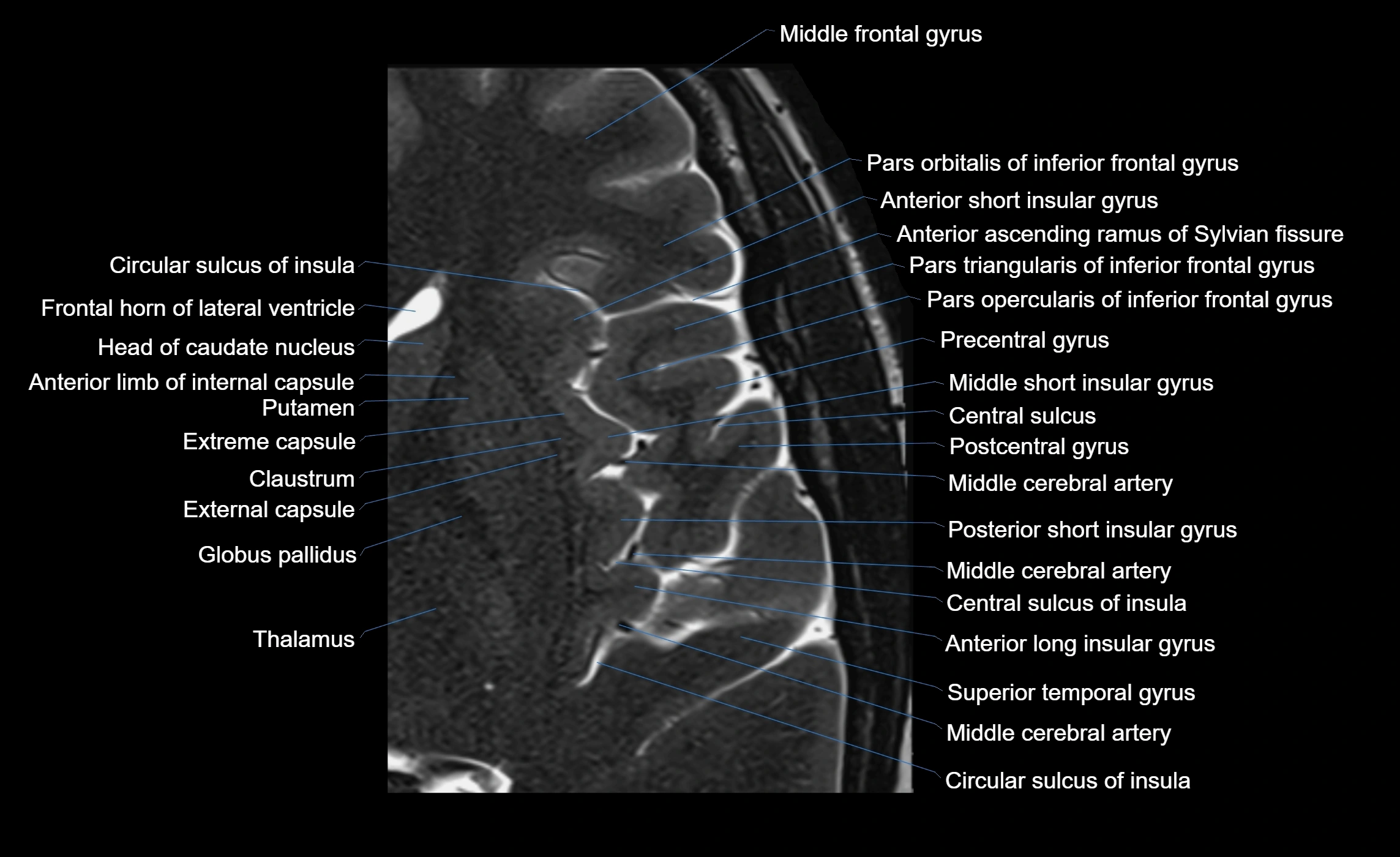Brain insula axial  anatomy 3T MRI image-img-00001-00012.webp